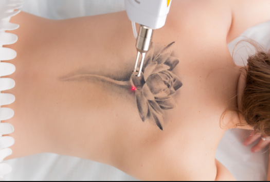 What Are Some Best Sources And Places To Make Your Tattoo Removal Without Getting Much Pain?