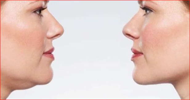 Remove Fat From The Face With The Treatment
