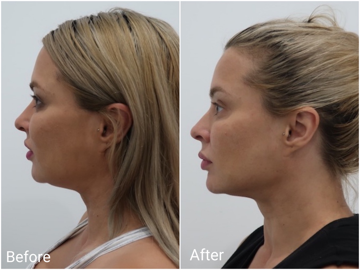 Types Of Facelift Treatments To Get Fresh And Tightened Skin In Gold Coast