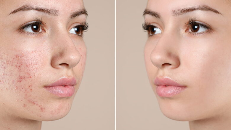 How to Choose an Acne Treatment Centre