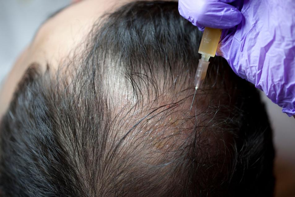 PRP Hair Restoration