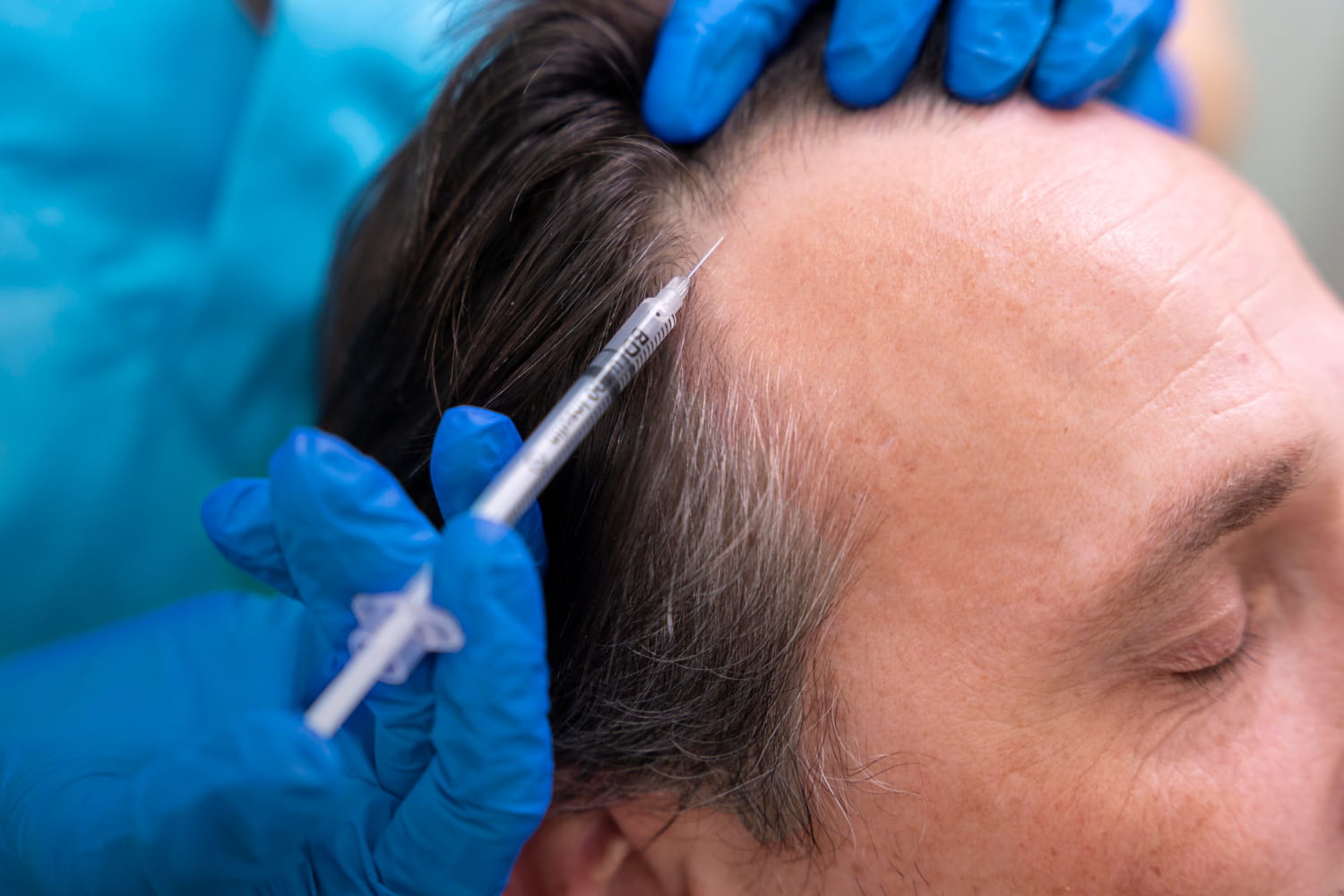 PRP for Hair Restoration & Loss in Nashville